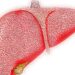 Cirrosis hepática