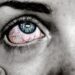 Conjuntivitis: entre los síntomas de Ómicron