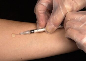 Tuberculosis
