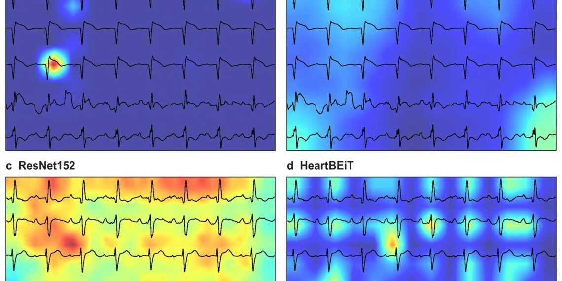 Diagnosing Heart Attacks With New AI Model