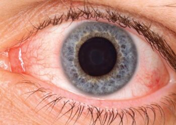 Aumentan los problemas de sequedad ocular durante el verano